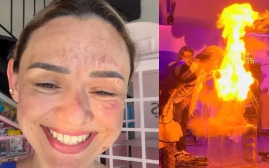 Arlen Hernández, la influencer de Tampa Bay, sufre quemaduras en el rostro por un ‘pastel explosivo’
